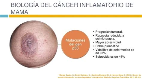 cancer de mama inflamatório